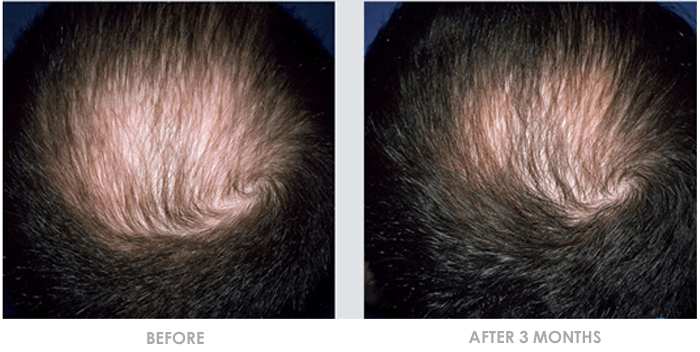 Rejuvalex Before and After