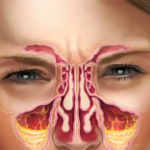Cure sinus in infection at Home