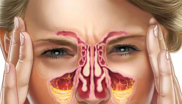 how-to-cure-sinus-infection-at-home-sinus-infection-quick-remedy