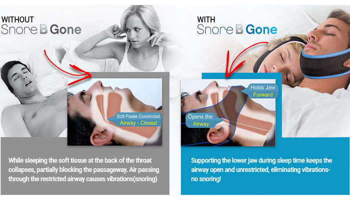 Snore B Gone Anti Snoring Solution