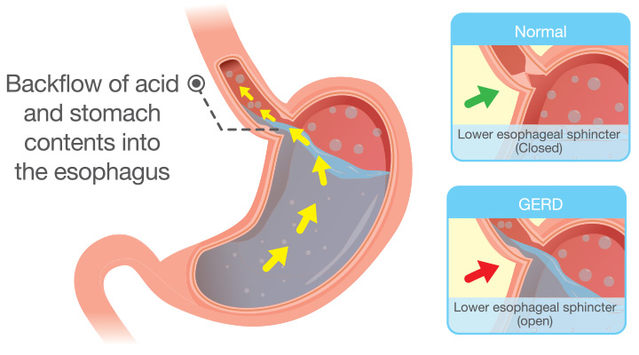 Best and Effective Natural Remedies for Acid Reflux in Babies!